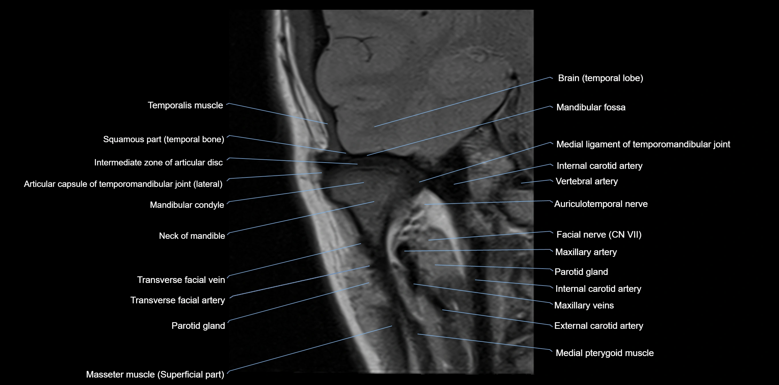 MRI TMJ coronal cross sectional 3T anatomy -img-00004-00007.webp